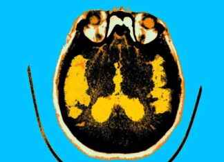 New Drug by Eli Lilly Shows Promise in Preventing Alzheimer’s Disease news-13102024-234104