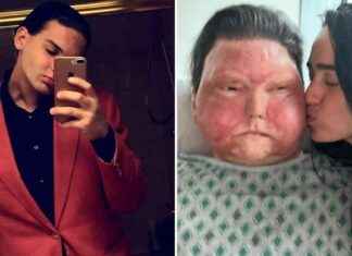 Engagement Photos of Man Who Received World’s First Face and Hands Transplant news-19112024-020036